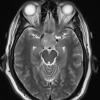 1A4 Pituitary Adenoma (Case 1) T2 W 1 - Copy