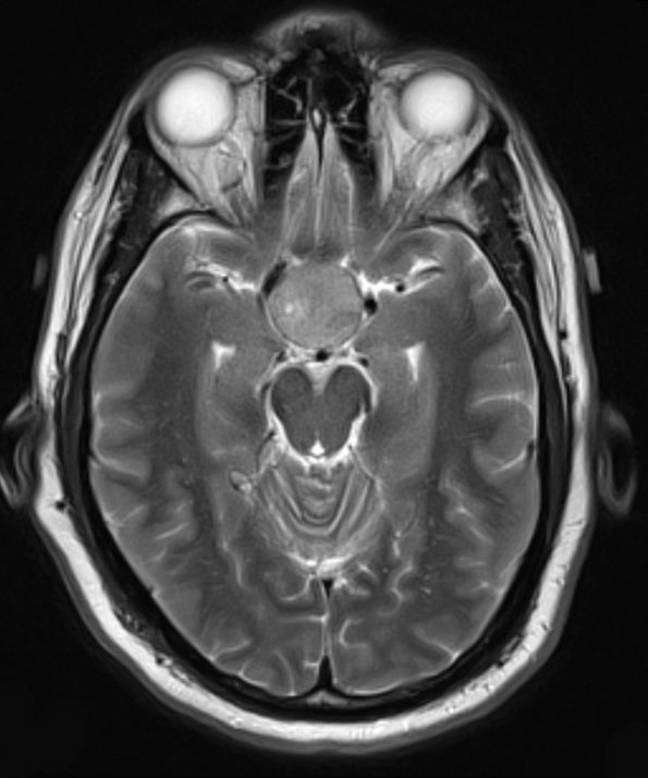 1A4 Pituitary Adenoma (Case 1) T2 W 1 - Copy