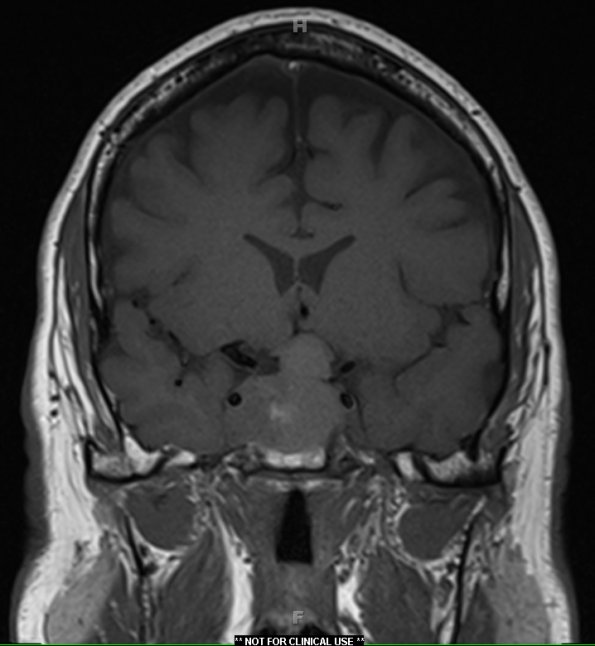 3A1 Pituitary adenoma (Case 3) T1 1 - Copy