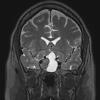 3A3 Pituitary Adenoma (Case 3) T2W - Copy