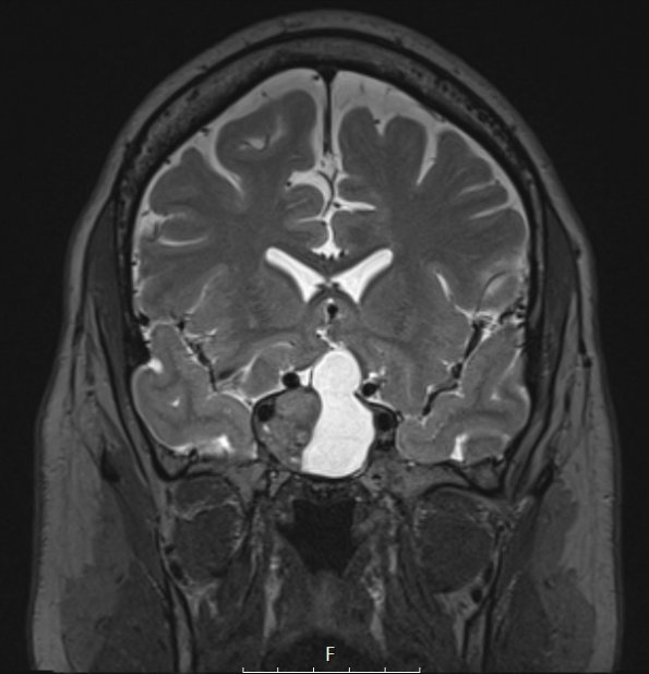 3A3 Pituitary Adenoma (Case 3) T2W - Copy