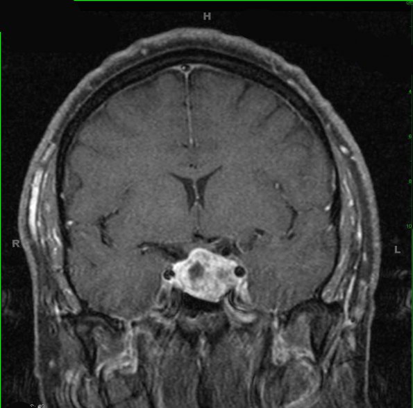 4A1 Pituitary adenoma (Case 4) T1 W 2 - Copy