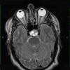 4A2 Pituitary adenoma (Case 4) T2 1 - Copy