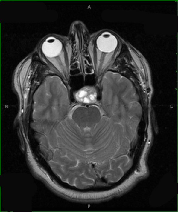 4A2 Pituitary adenoma (Case 4) T2 1 - Copy