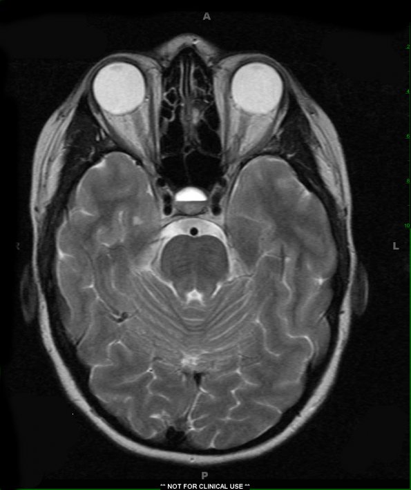 5A Pituitary Adenoma (Case 5) MRI fluid level T2 - Copy