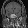 7A Pituitary Adenoma (Case7) T1 W 4 - Copy