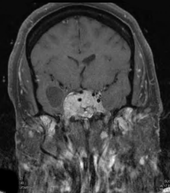 7A Pituitary Adenoma (Case7) T1 W 4 - Copy