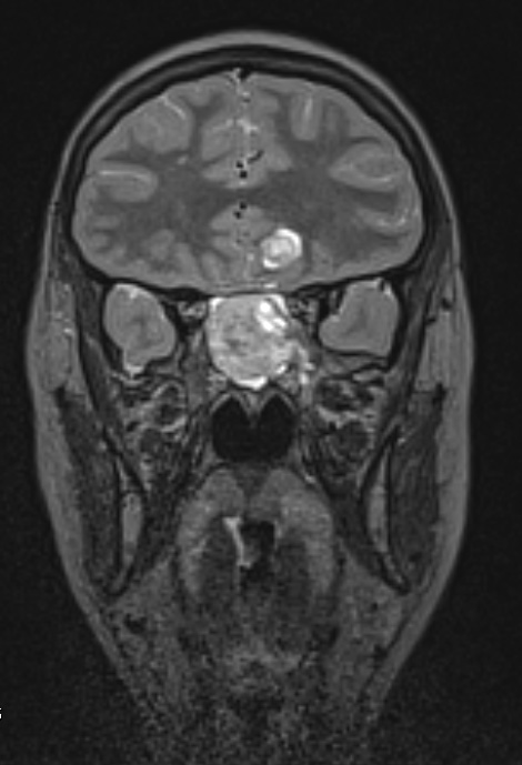 8A1 Pituitary adenoma (Case 8) Cor Space Pituitary W - Copy