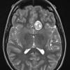 8A2 Pituitary adenoma (Case 8) T2 W 1 - Copy