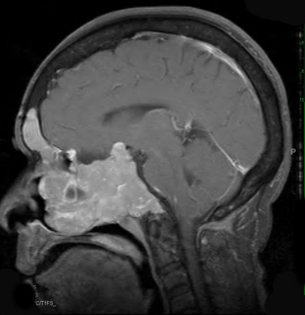 9A2 Pituitary Adenoma (Case 9) T1 W 3 - Copy