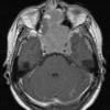 9A3 Pituitary Adenoma (Case 9) T1 W 1 - Copy