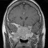 9A4 Pituitary Adenoma (Case 9) T1 W 2 - Copy