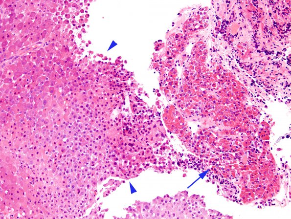 10A1 PA, ACTH (Case 10) H&E 4A