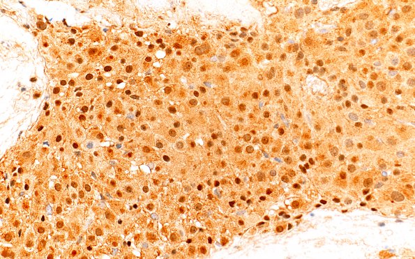 10B3 Pituitary Adenoma, ACTH (Case 10) ACTH 40X 2