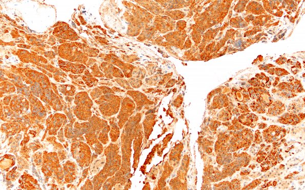 10C2 Pituitary Adenoma, ACTH (Case 10) PRL 20X