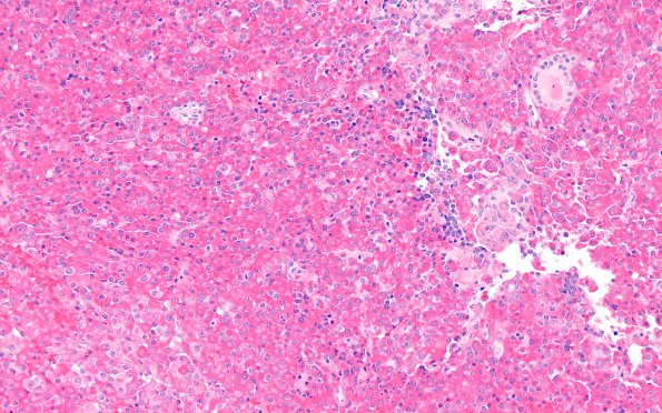 11A2 Pituitary Adenoma, plurihormonal (Case 11) H&E 10X - Copy