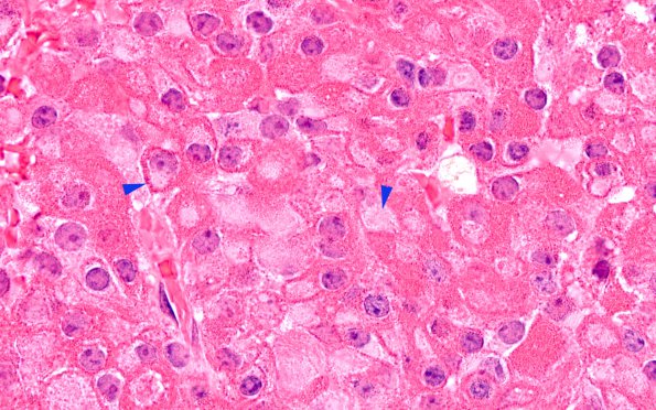 11A4 Pituitary Adenoma, plurihormonal (Case 11) H&E 100X 3 copy