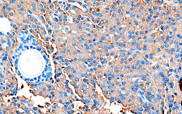 11D2 PA, Pluri (Case 11) GH sparsely granulated 40X