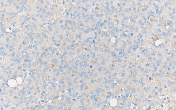 1E2 PA, Pluri (Case 1) 40X PRL rich area GH stain