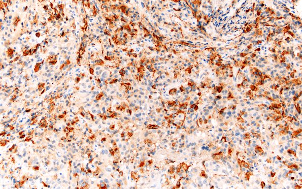 2D2 Pluri (Case 2) PRL 20X