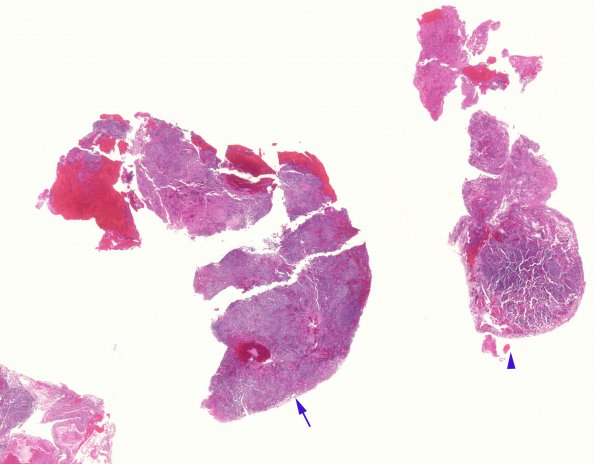 7A1 PA, separate PRL, FSH (Case 7) H&E copy copy