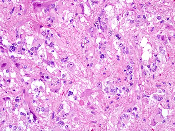 8B7 PA & GGL diffn (Case 8)  (ggl) H&E A1