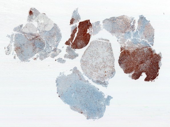 8C1 PA & GGL diffn (Case 8) Prolactin WM