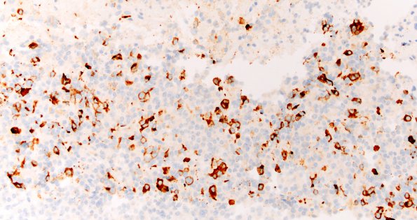 8C4 PA & GGL diffn (Case 8) Prolactin 20X