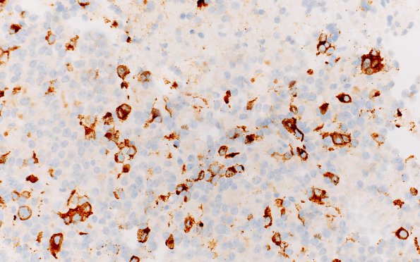 8C5 PA & GGL diffn (Case 8) Prolactin 40X 2