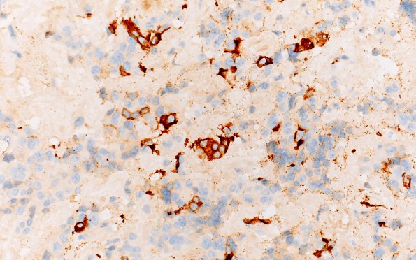 8C6 PA & GGL diffn (Case 8) Prolactin 40X