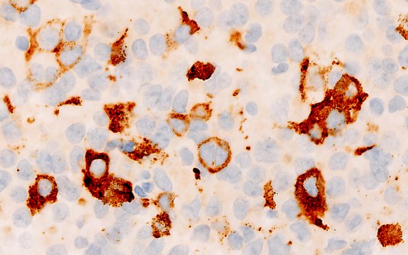 8C7 PA & GGL diffn (Case 8) Prolactin 100X 1