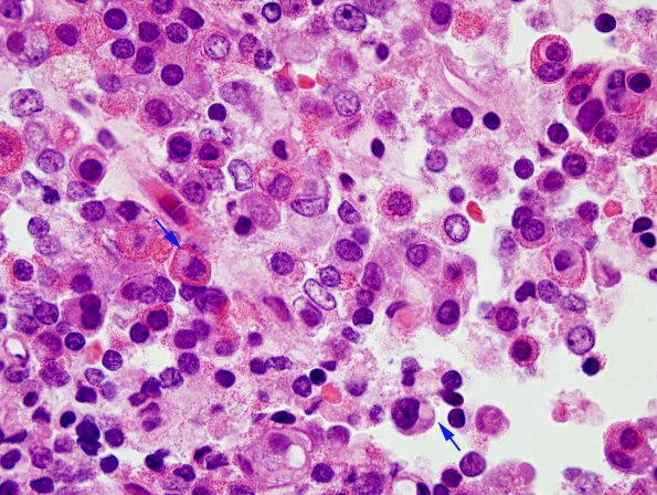 9A2 PA, fib bodies (Case 9) H&E 7 copy.jpg