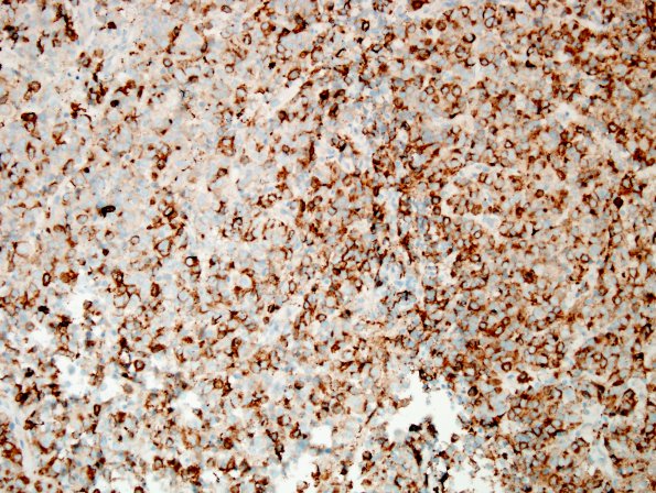 9C PA, fib bodies (Case 9) Prolactin 2.jpg