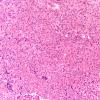 2A1 Pituitary adenoma GH FB (Case 2) H&E 20X