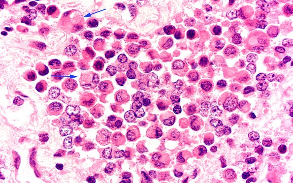 2A3 Pituitary adenoma GH FB (Case 2) H&E 100X A