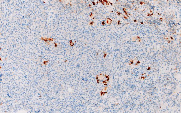 2C2 Pituitary adenoma GH FB (Case 2) PRL 20X