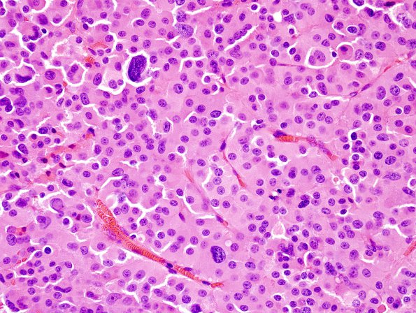 3A1 Pituitary adenoma, GH (Case 3) H&E 3.jpg