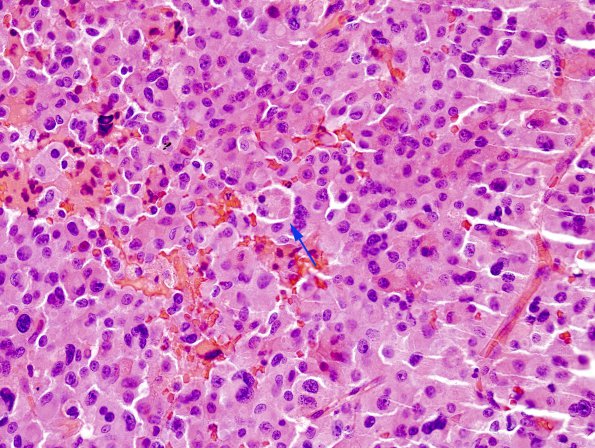 3A3 Pituitary adenoma, GH (Case 3) H&E 4 copy.jpg