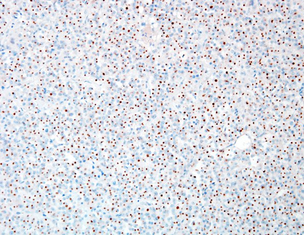 3C1 Pituitary adenoma, GH (Case 3) panCK 1.jpg