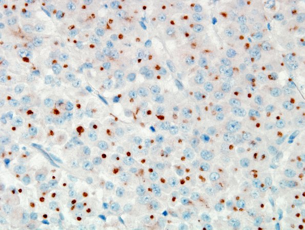 3C2 Pituitary adenoma, GH (Case 3) panCK 2.jpg