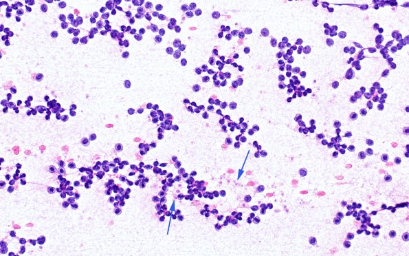 6A2 PA (Case 6) H&E Smear 40X 2 copy