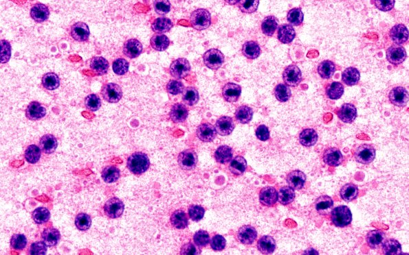 6A3 PA (Case 6) H&E smear 100X