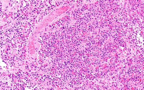 8B1 Adenoma, GH (Case 8) H&E 20X 1
