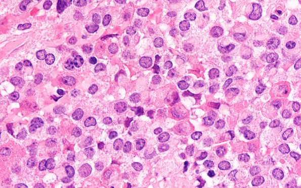 8B4 Adenoma, GH (Case 8) H&E 100X 2