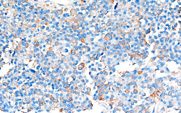 8C1 Adenoma, GH (Case 8) GH 40X 1