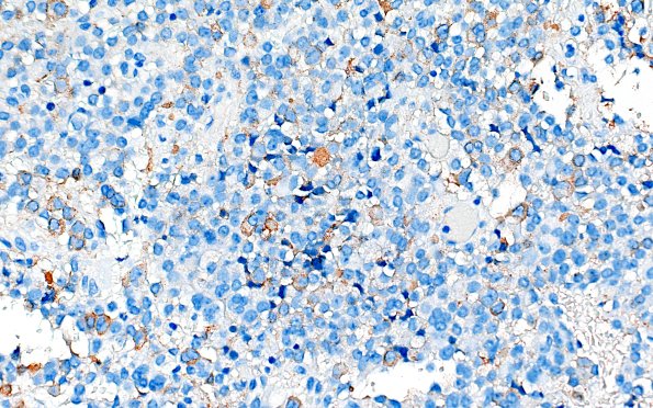 8C2 Adenoma, GH (Case 8) GH 40X 2