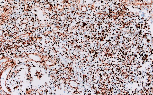 8D1 Adenoma, GH (Case 8) CAM5.2 20X 1