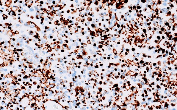 8D2 Adenoma, GH (Case 8) CAM5.2 40X 1