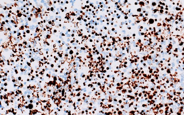 8D3 Adenoma, GH (Case 8) CAM5.2 40X