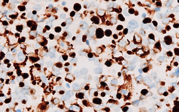 8D4 Adenoma, GH (Case 8) CAM5.2 100X 1